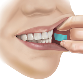 A PharmFilm® medication being applied to the inside of a cheek (buccal delivery)